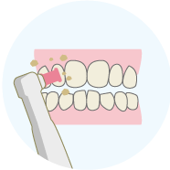 歯のクリーニング歯垢・歯石の除去