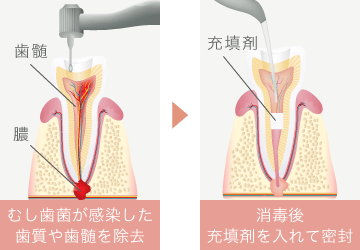 むし歯菌が感染した歯質や歯髄を除去、消毒後充填剤を入れて密封