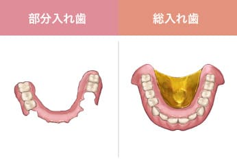 部分入れ歯・総入れ歯