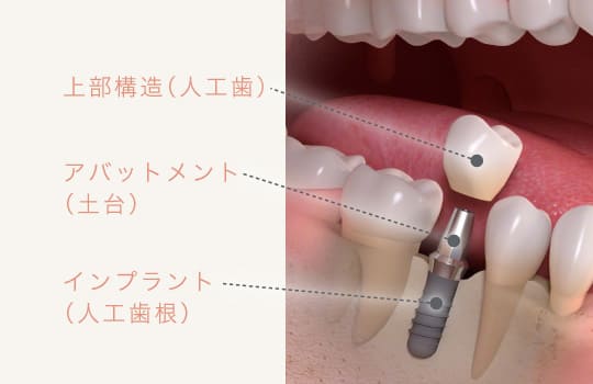 上部構造、アバットメント、インプラント