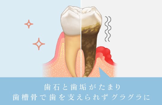 歯石と歯垢がたまり歯槽骨で歯を支えられずグラグラに